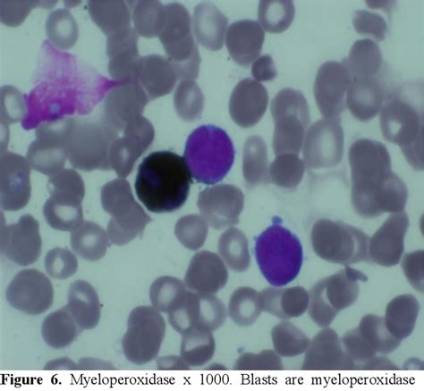 Figure 6 From Osteolytic Bone Lesions A Rare Presentation Of Aml M6