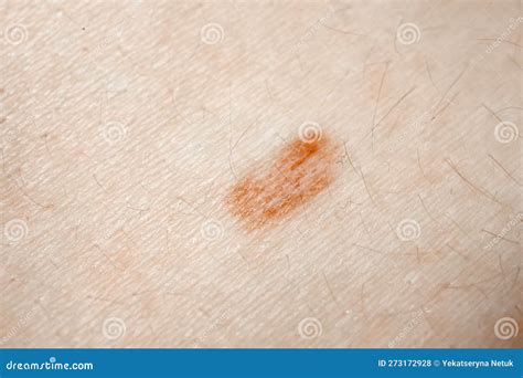 Mole Birthmark Nevus Macro Photo On Human Skin Crochordon Or Soft