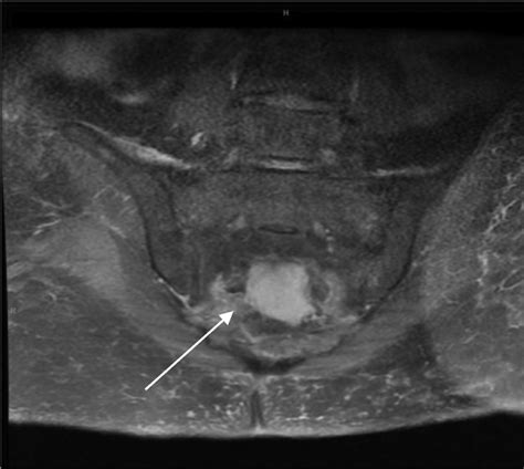 Coronal T2 Weighted Fat Sat MRI Image Of The Sacrum Demonstrating Bone