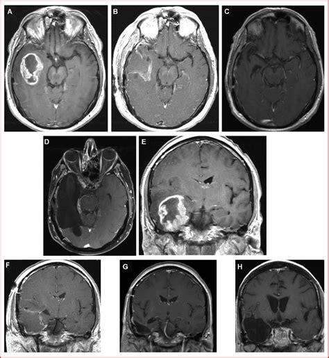 Preoperative Postcontrast Axial A And Coronal E T1 Weighted Mri Of