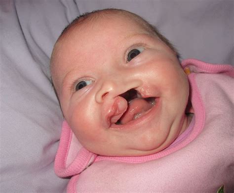 Cleft Lip And Palate Association Cleft Lip And Palate Cleft Lip Cleft