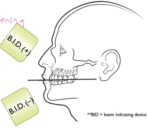 Intraoral Imaging Technique Flashcards Quizlet