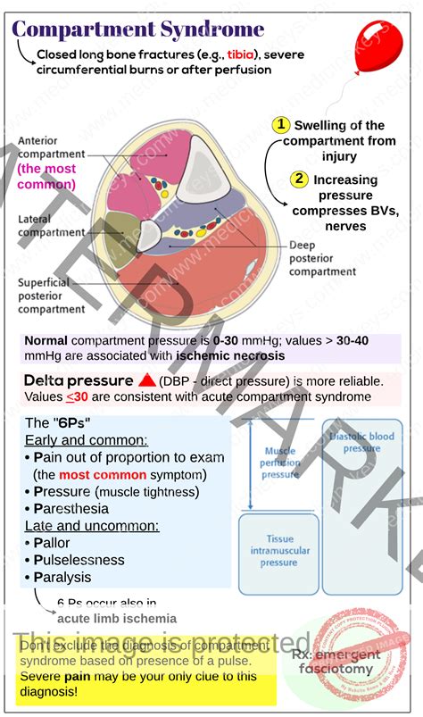 Compartment Syndrome Medicine Keys For Mrcps