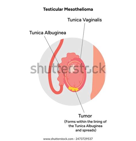 Mesothelioma Disease Testicular Diagram Zoom Stock Vector Royalty Free