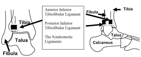 High Ankle Sprain Treatment - Atlanta Foot Doctor - Silverman Ankle & Foot