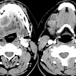 Pre Operative CT Neck Imaging Axial Computed Tomography CT With