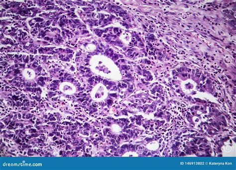 Gastric Adenocarcinoma Light Micrograph Stock Photo Image Of