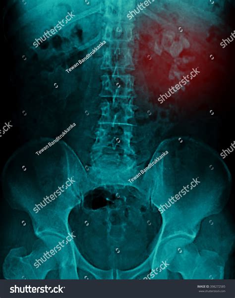 Kidney Stone Renal Stone Renal Calculi Stock Photo 398272585 Shutterstock