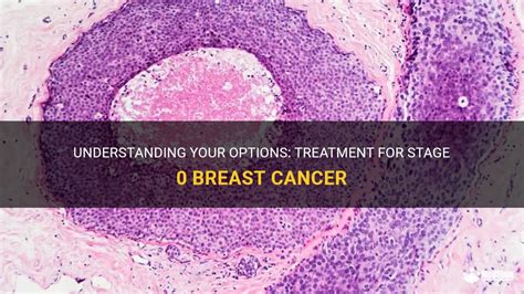 Understanding Your Options: Treatment For Stage 0 Breast Cancer | MedShun