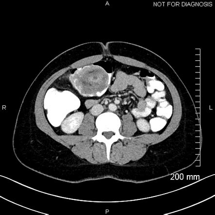 Colocolic Intussusception Due To Mucinous Carcinoma Of The Colon