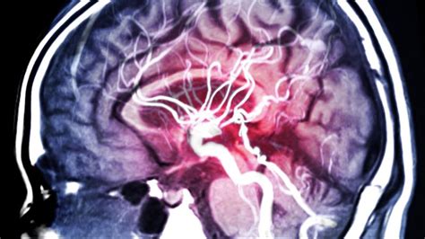 Improved Motor Sensory And Cognitive Recovery After Stroke Sciena