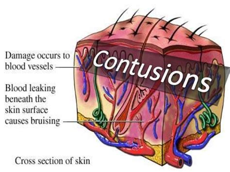 contusion - définition - What is