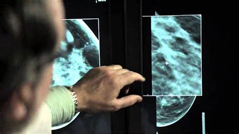 3d Mammography Detecting Breast Cancer At An Earlier Stage Youtube