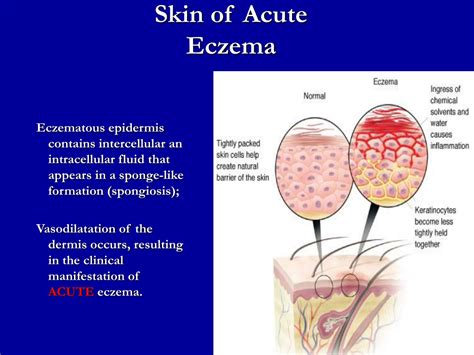 Ppt Eczema Powerpoint Presentation Free Download Id9721625