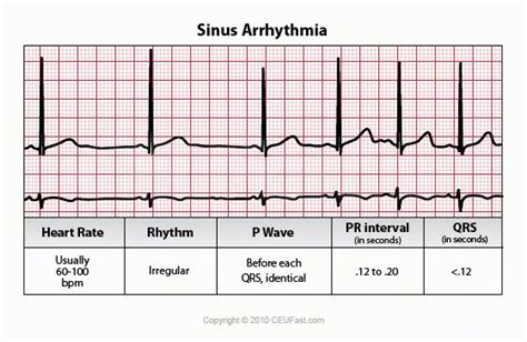 Sinus Arrhythmia Ecg Interpretation Continuing Education For Nurses Medical Surgical Nursing