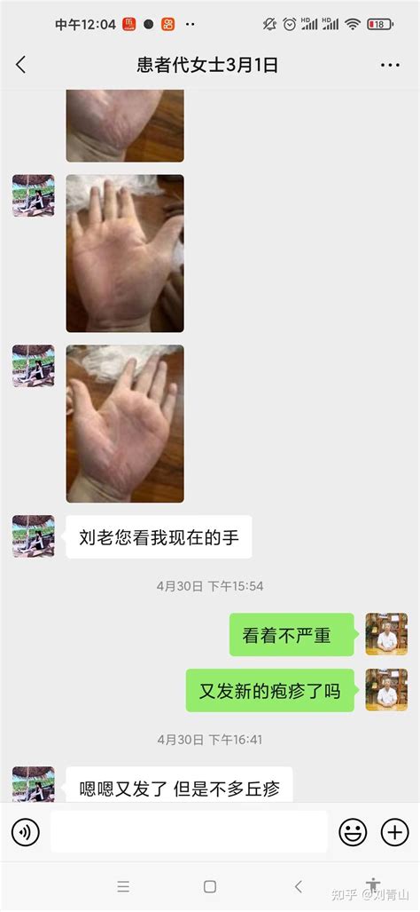 记录一下掌跖脓疱病患者代女士的治疗痊愈的四个月全过程 知乎