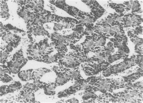 Photomicrograph Showing Clusters Of Tumour Cells Separated By Delicate