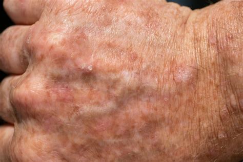 Actinic Keratosis Vero Beach Ocean Drive Dermatology