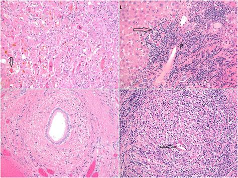 Top Left H E Stain Showing Acute Hepatitis With Lobular Disarray And