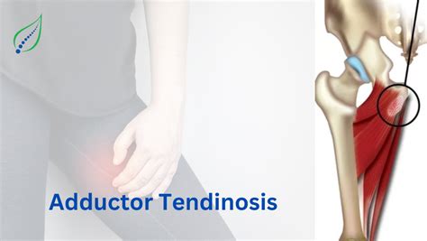 Best Adductor Tendinosis Treatment | Spinalogy Pune | Best Back Pain ...