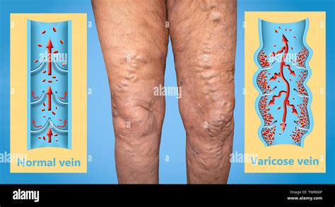 Varicose Veins On A Female Senior Legs The Structure Of Normal And