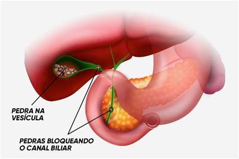 Sintomas Que Podem Indicar Pedra Na Ves Cula Tua Sa De