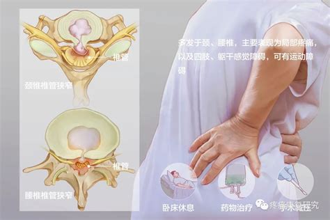 腰椎管狭窄症的病因分型症状检查及诊断和治疗 MedSci cn