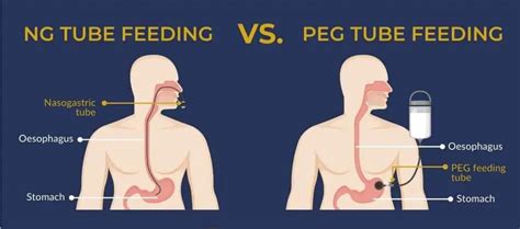 Peg tube vs G tube - E Phlebotomy Training