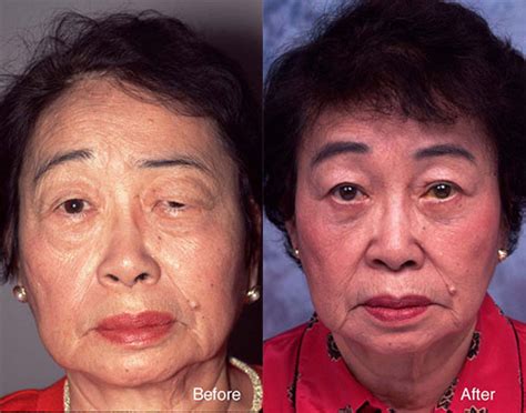 Bell S Palsy Beverly Hills Facial Paralysis Treatment Los Angeles