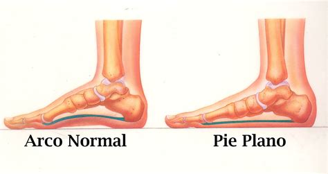 Pie Plano Orthopedic Medicos Ortopedistas