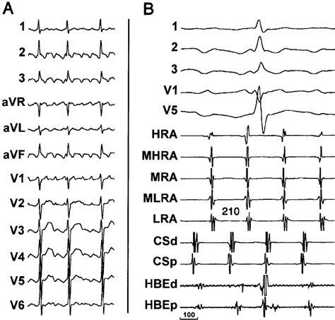 Twelve Lead Ecg A And Intracardiac Recordings B Of The Presenting