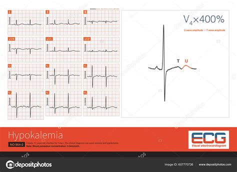 Patient Suffered Hypokalemia Due Diarrhea Note Amplitude Wave Lead ...