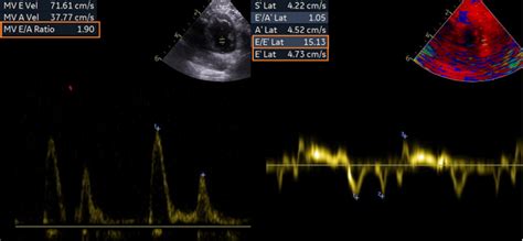 고양이 심근병증 제한성 심근병증 Rcm Restrictive Cardiomyopathy 심근형 Myocardial Form 이완기능장애 네이버 블로그