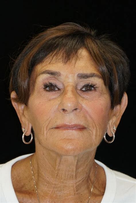 Before And After Dermabrasion Procedures In Newport Beach Dr Richland