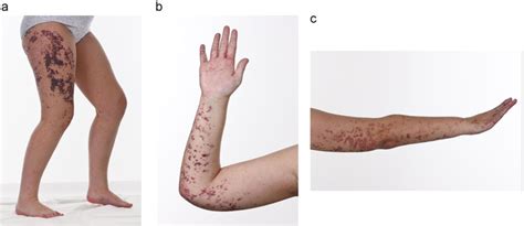 A B C Angiokeratoma Corporis Diffusum On The Right Thigh Right Palm Download Scientific