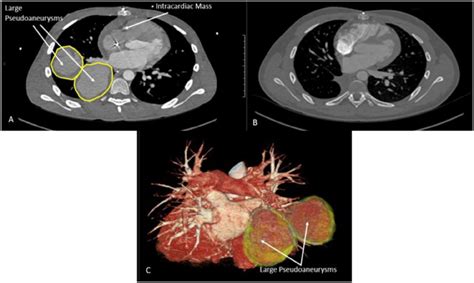 Successful Medical Surgical Management Of Intracardiac Thrombosis And