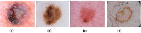 Different Types Of Skin Lesions A Mel B Ben C Nv And D Sk Download Scientific Diagram