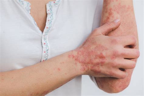 Penyakit Psoriasis Punca Tanda Dan Rawatan Tips Kesihatan