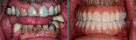 Implant Supported Dentures