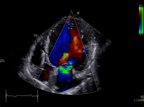 Echocardiography Mhvi