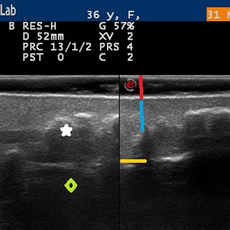 Right Suprapatellar Soft Tissues Ultrasound Abnormal Skin With