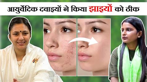 Melasma को Ayurvedic Treatment से किया 100 ठीक😱dark Spots And Patches Patient Review Youtube