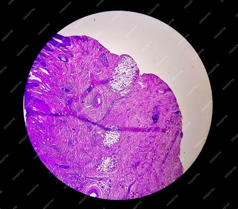 La Vista Microscópica Del Carcinoma Basocelular Es Un Tipo De Cáncer De