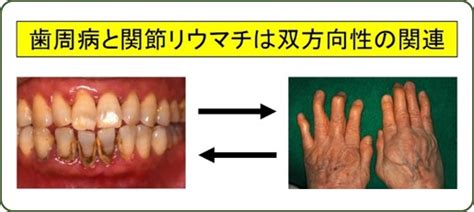 歯周病による関節リウマチ発症・悪化機序の解明 新潟大学 社会連携推進機構