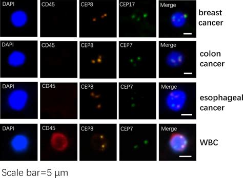 Detection of tumour cells. The expression level of CD45 and the number ...