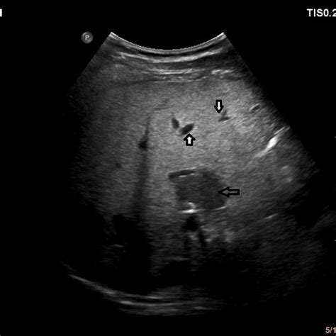 Fatty Liver Grade 2 B Mode Ultrasonography A 47 Year Old Female