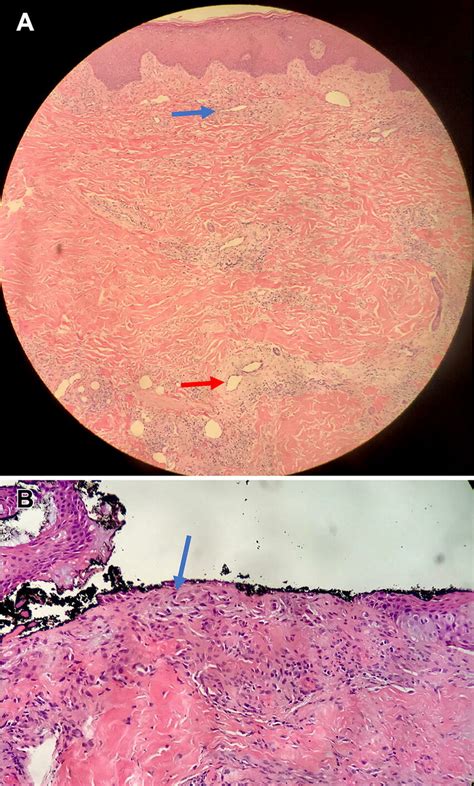 A Hematoxylin And Eosin Hande Stain Of Skin Punch Biopsy At 400×