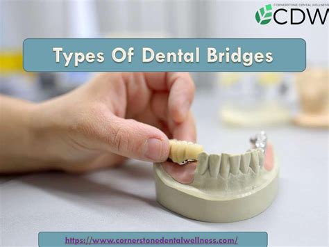 Types Of Dental Bridges by Cornerstone Dental Wellness - Issuu