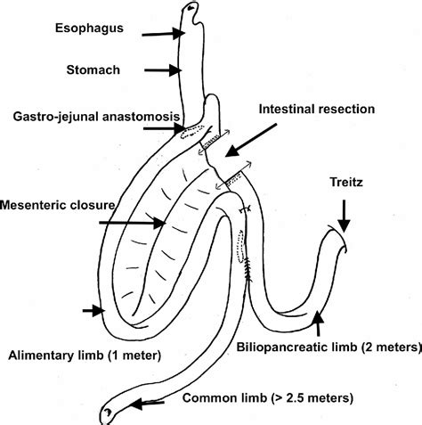 Laparoscopic Revision Of An Omega Loop Gastric Bypass To Treat Afferent Loop Syndrome Semantic