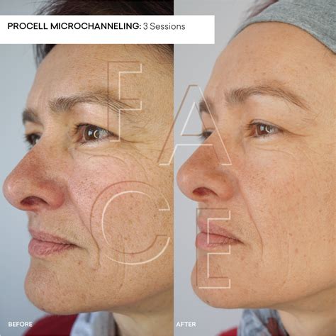 Procell Microchanneling Before and After — FACE